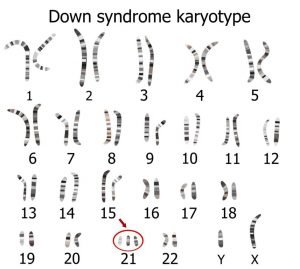 bilder von chromosomen zur Trisomie 21