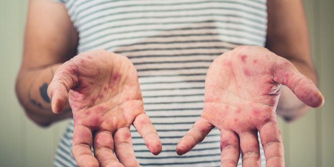 Hand Fuss Mund Krankheit Tipps