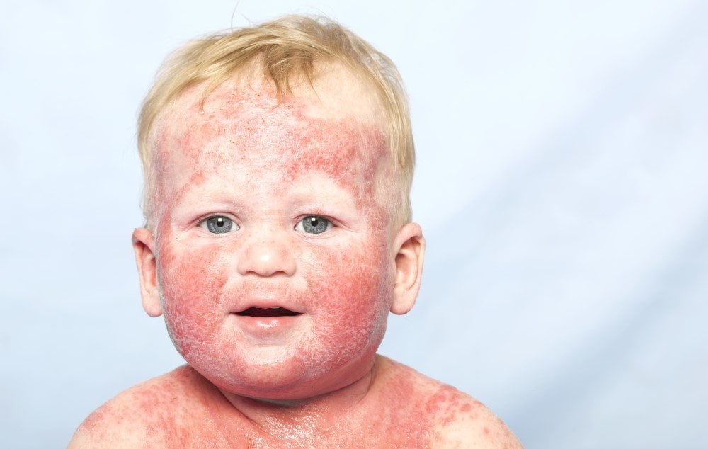 Neurodermitis bei Kindern - So gehen Sie mit der Hautkrankheit um