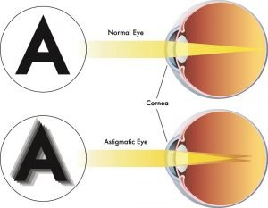 látás stigmatista szemek érrendszeri eredetű látásromlás elleni gyógyszerek