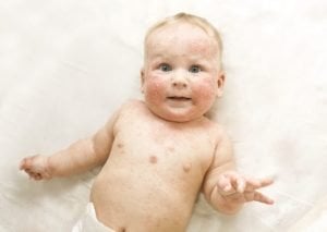 Erstaunlich Ausschlag Baby Zahnen Ebenbild