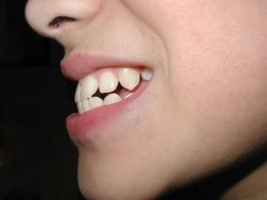 Kind zeigt Zähne