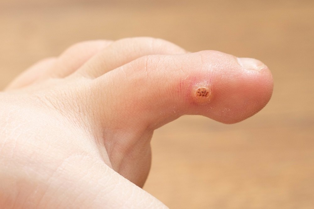 Fingernagel warze entfernen unterm Hausmittel gegen