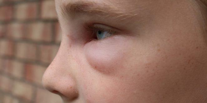 Geschwollene Augen Beim Kind Ursachen Und Behandlungsmoglichkeiten