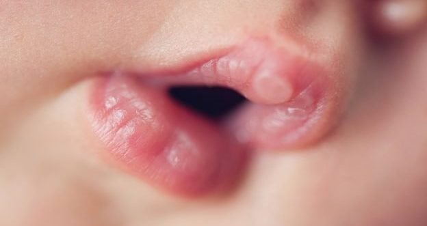 Herpes am mund heilt nicht
