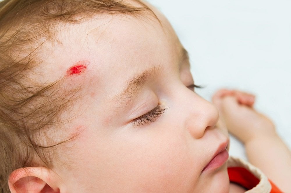 Gehirnerschütterung beim Kind Das sind die Symptome und Behandlung