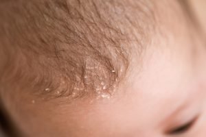 Kopfgneis bei einem Baby