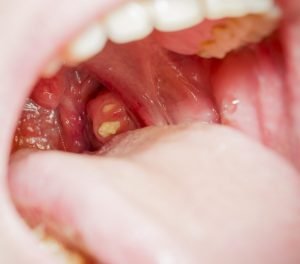 geöffneter Mund bei akuter Tonsillitis