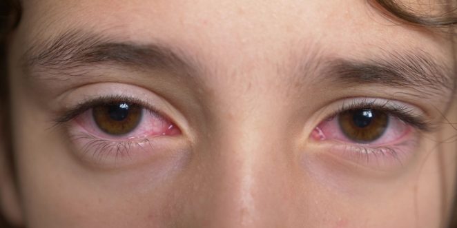 Nicht auge weg im geht schleim Augeninfektionen