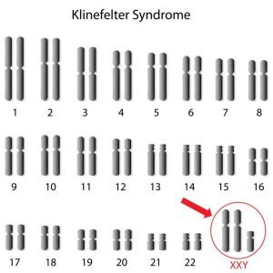 Chromosomenpaare beim Klinefelter-Syndrom